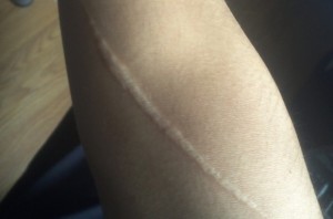 Picture of my forearm scar